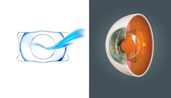 ICL implantable contact lens for spectacle-free vision