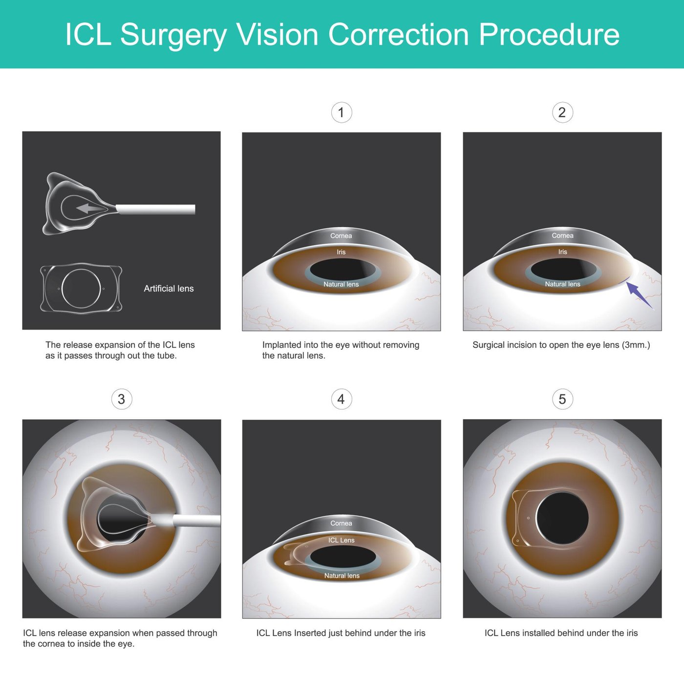ICL vision correction procedure shown step by step