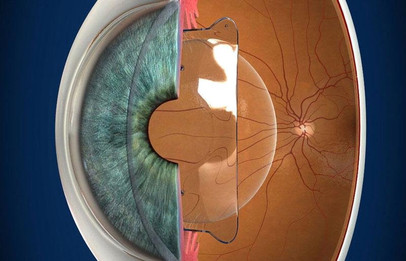 Cross-section showing an artificial lens positioned inside the eye