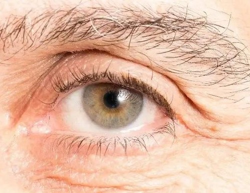 Clear white eye after pterygium surgery at ShivAnuj Eye Hospital, Vadodara