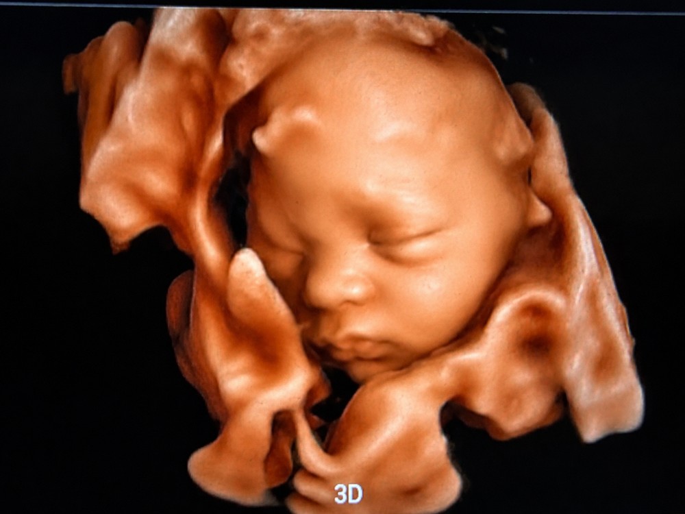 3D pregnancy ultrasound surface portrait of a baby's face at ShivAnuj Eye Hospital & Diagnostic Center, Vadodara