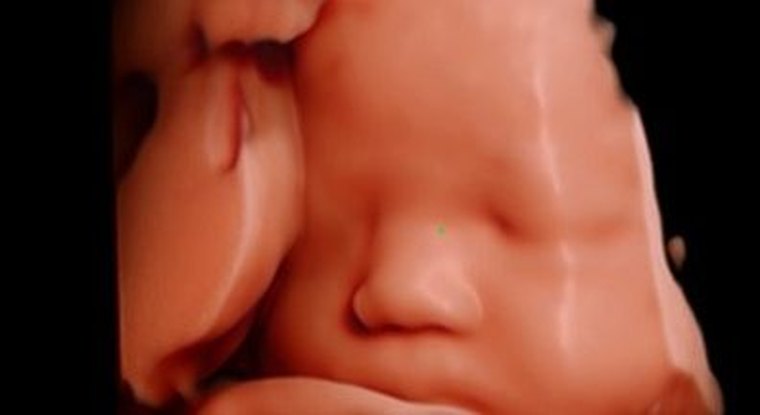 3D and 4D fetal ultrasound surface portrait of a baby in the womb
