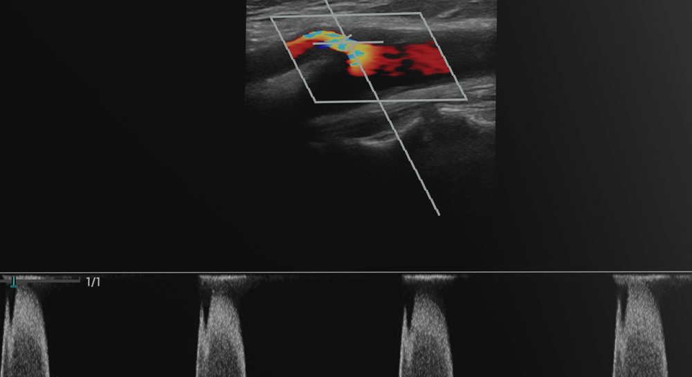 Colour Doppler study showing vascular blood-flow mapping with spectral waveform
