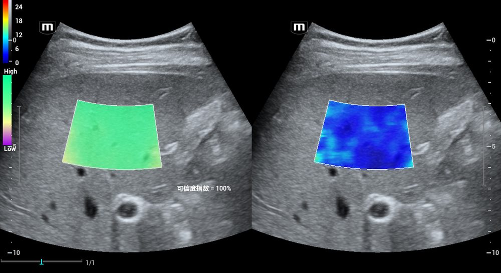 Shear-wave elastography and liver fat quantification ultrasound