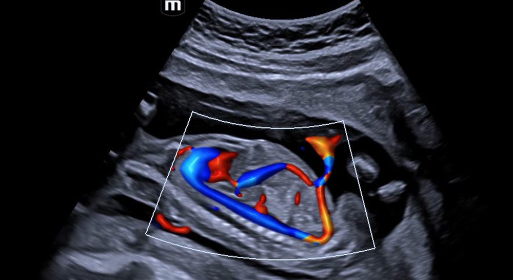 Obstetric colour Doppler ultrasound at ShivAnuj Eye Hospital & Diagnostic Center, Vadodara