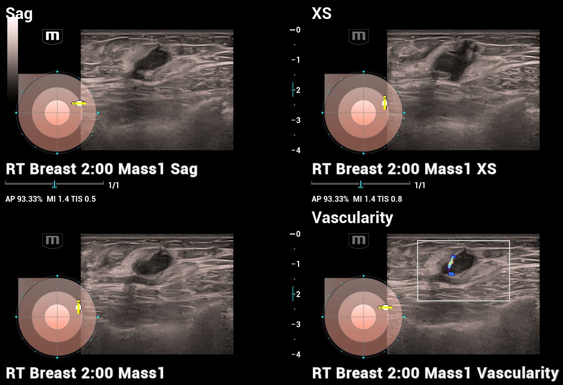 Sonomammography, ultrasound evaluation of the breast